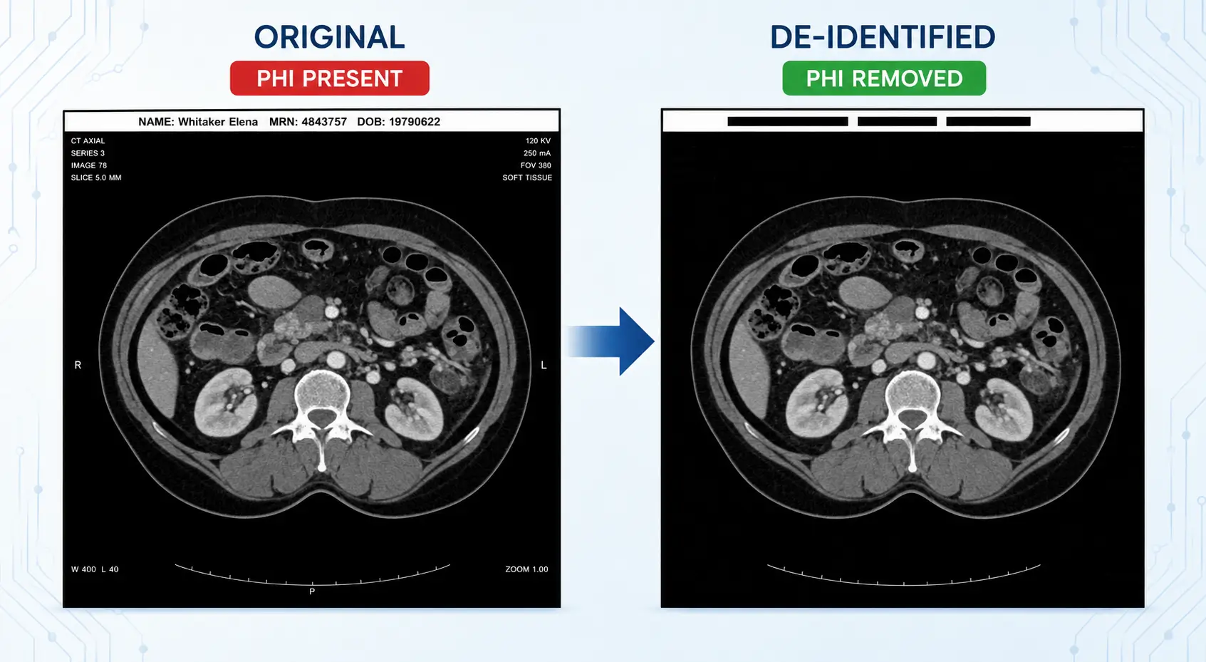 CT scan before and after PHI de-identification.