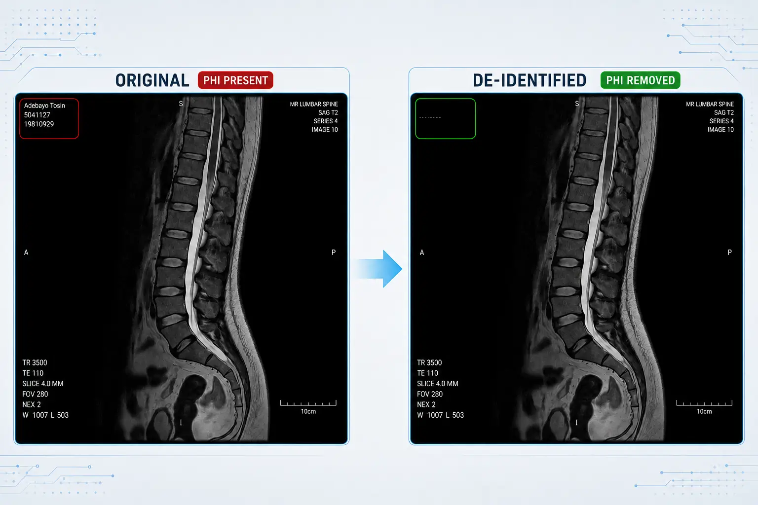 DICOM MRI de-identification removing patient information from a medical image while preserving clinical content.